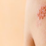Herpes: different types and how to prevent them
