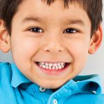 La ortodoncia: Porque es importante corregir los dientes