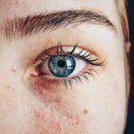 Eye styes. Causes, symptoms and treatments