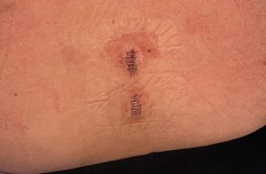 incision endoscopia de columna